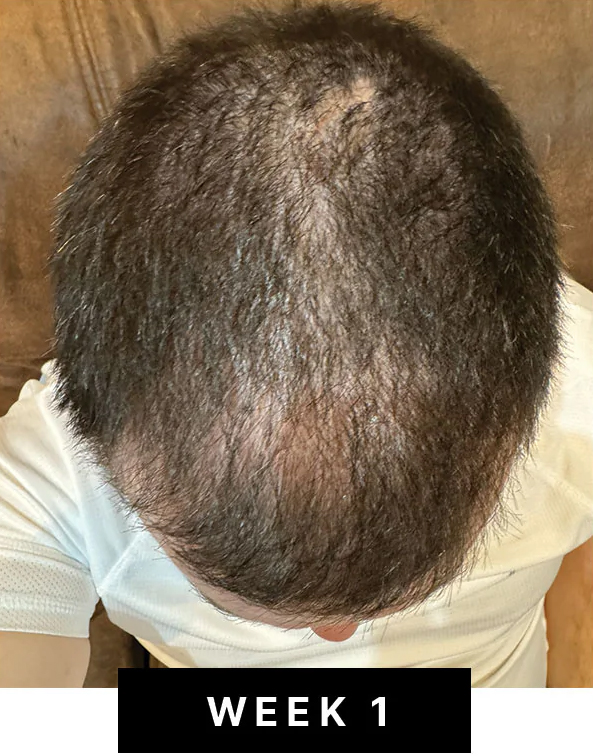 Week 1 hair density photo