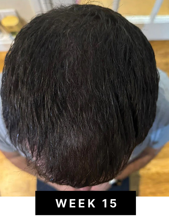 Week 15 hair density photo