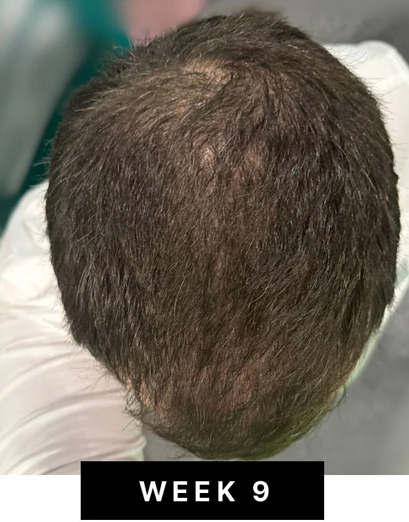 Week 9 hair density photo
