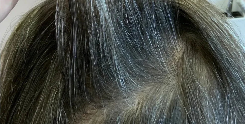 The same crown after using HUSSSH, with less scalp showing
