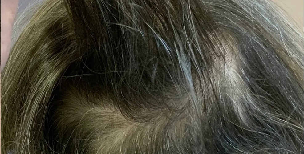 A customer's crown before using HUSSSH, with scalp showing