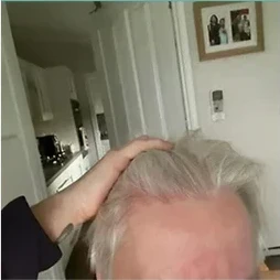 Elaine's hairline before using HUSSSH