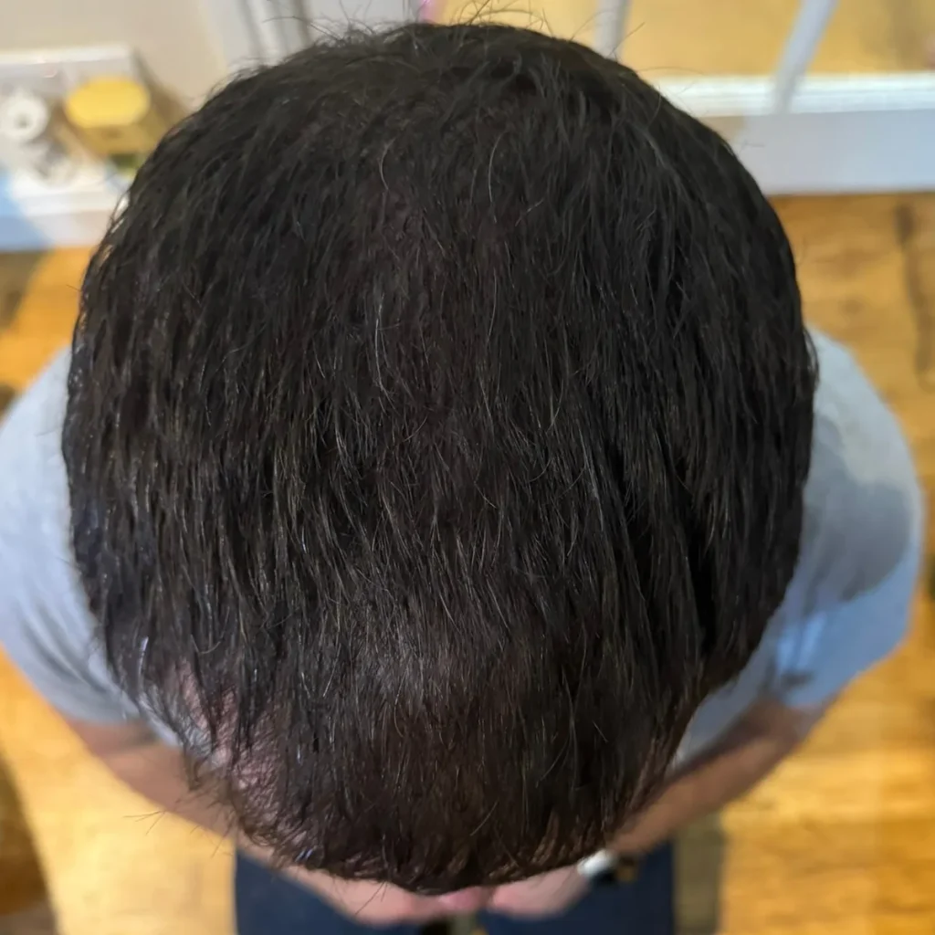 Top of Kevin's head in November 2024, after about 12 weeks of HUSSSH, with the crown looking thicker and fuller