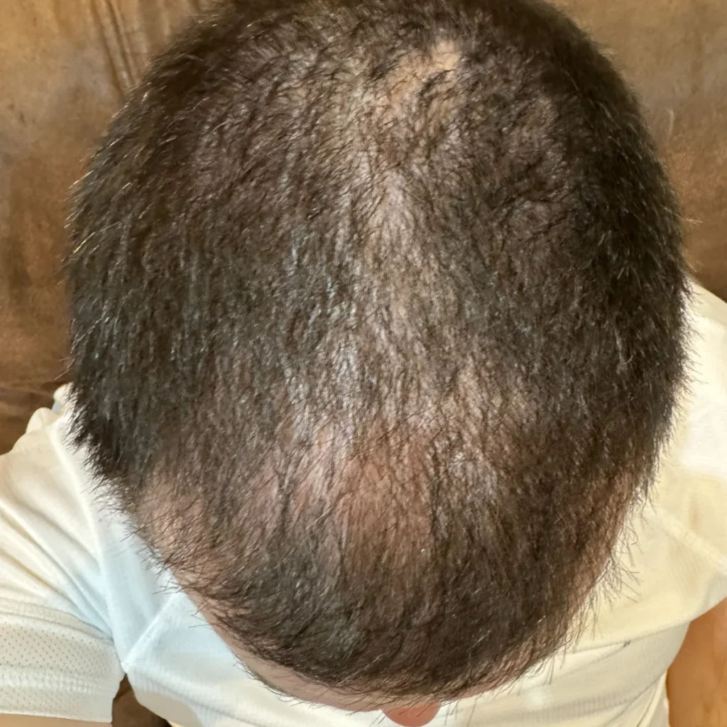 Top of Kevin's head in August 2024, before using HUSSSH, with scalp visible through thin hair at the crown