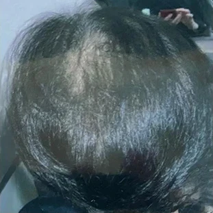 Sally's hair from above after about four months of HUSSSH, looking fuller across the top of her head