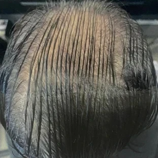 Sally's hair from above before using HUSSSH, with scalp showing across the top of her head